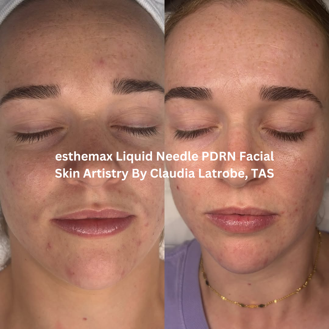 Before and after images of the face following an esthemax Liquid Needle PDRN Facial at Skin Artistry By Claudia in Latrobe, Tasmania. The after image shows calmer-looking skin with improved hydration, reduced visible redness, and a smoother overall complexion.