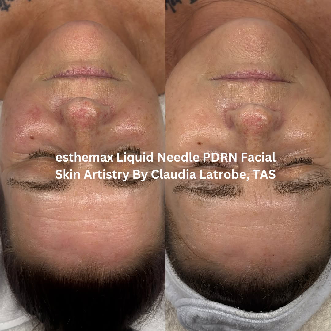 Progress images following ongoing esthemax Liquid Needle PDRN Facial treatments at Skin Artistry By Claudia in Latrobe, Tasmania. The after image shows improved skin clarity, enhanced radiance, and a more even-looking complexion.