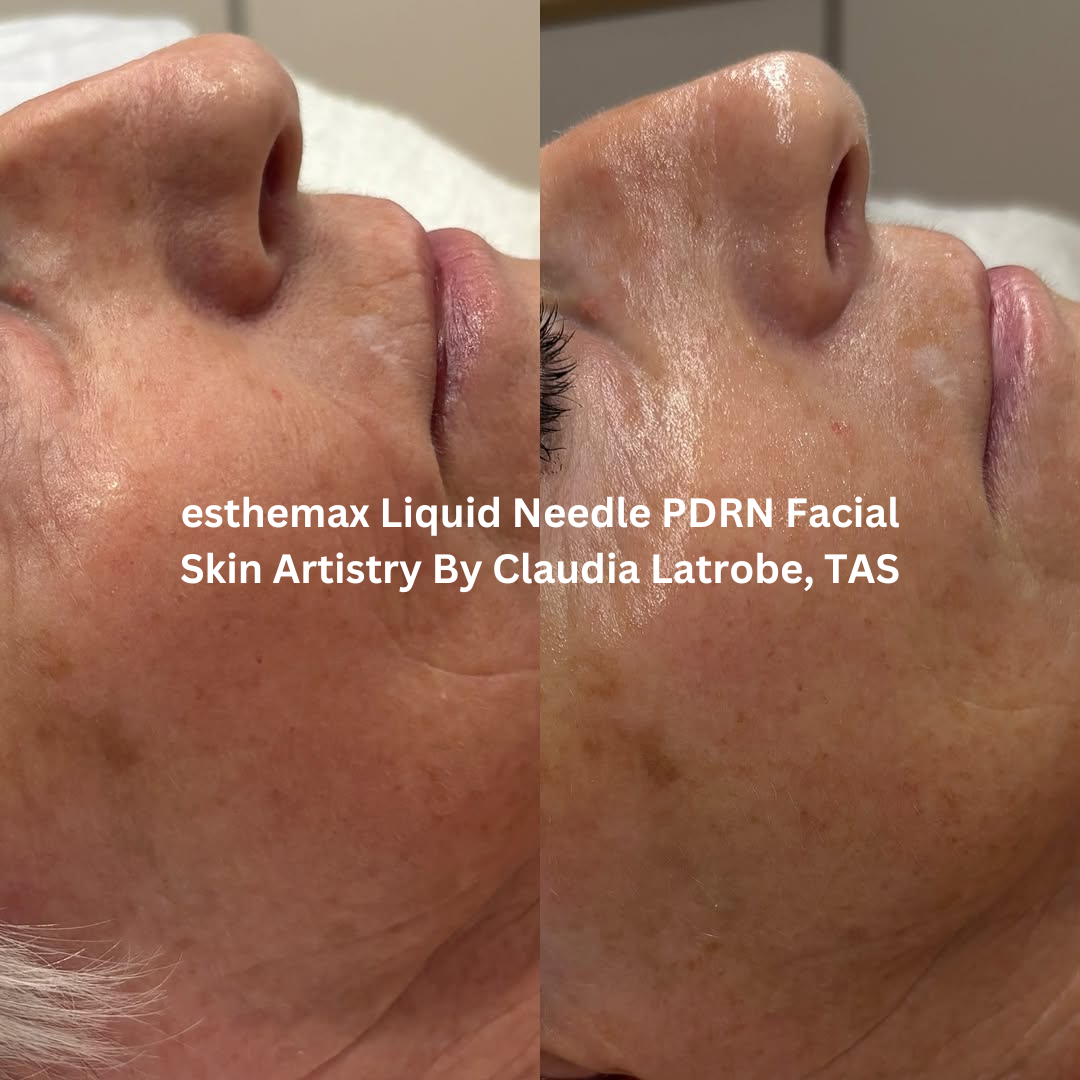 Progress images of the cheek and lower face following esthemax Liquid Needle PDRN Facial treatments at Skin Artistry By Claudia in Latrobe, Tasmania. The after image shows enhanced radiance, smoother-looking skin, and improved overall skin quality.