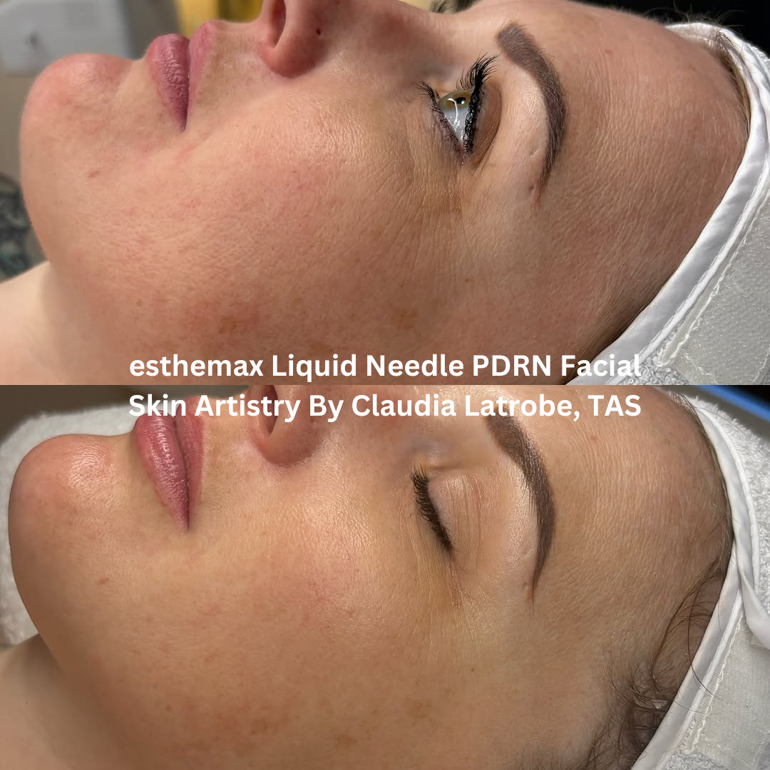 Progress images of the cheek and lower face following esthemax Liquid Needle PDRN Facial treatments at Skin Artistry By Claudia in Latrobe, Tasmania. The after image shows enhanced radiance, smoother-looking skin, and improved overall skin quality.