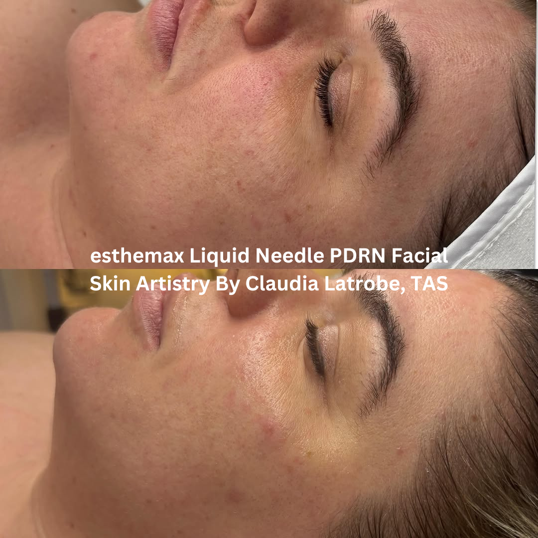 Before and after esthemax Liquid Needle PDRN Facial, demonstrating smoother skin texture, improved hydration, and a healthy post-treatment glow.