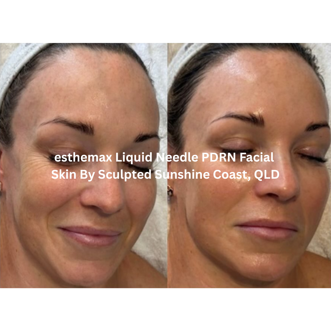 Before and after results of an esthemax® Liquid Needle PDRN Facial performed at Skin by Sculpted on the Sunshine Coast, Queensland. The client’s skin shows improved firmness, smoothness, and refined tone following gentle spicule-based regeneration.