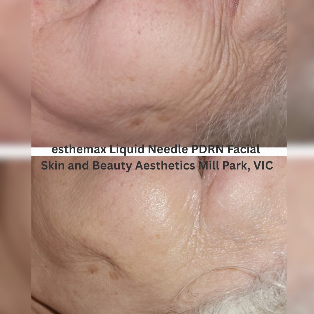 Before and after close-up images of the cheek and eye area following an esthemax® Liquid Needle PDRN Facial at Skin and Beauty Aesthetics in Mill Park, Victoria. The after image shows visibly hydrated skin with improved smoothness and a brighter, more radiant appearance.