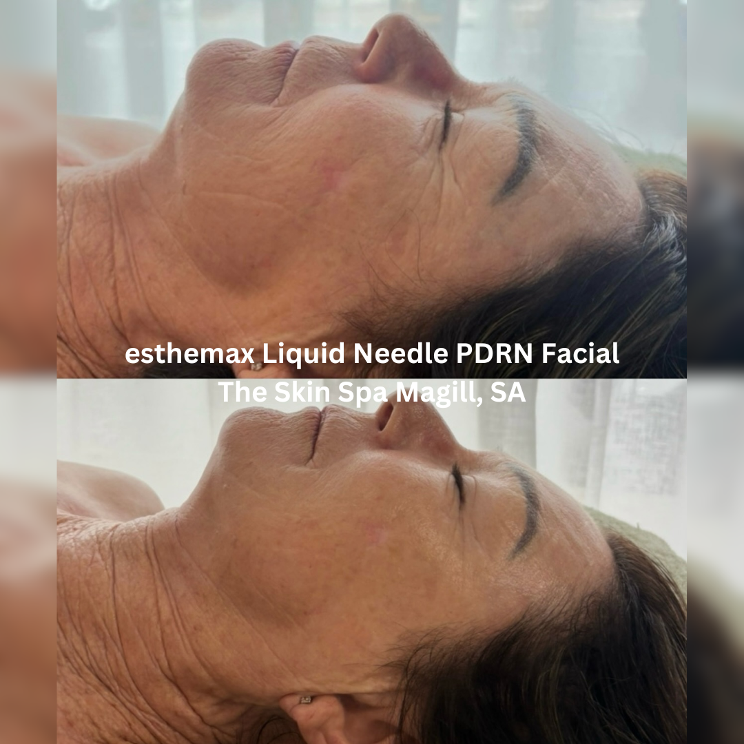 Before and after esthemax Liquid Needle PDRN Facial, showing brighter, firmer-looking skin with improved hydration and smoother texture.