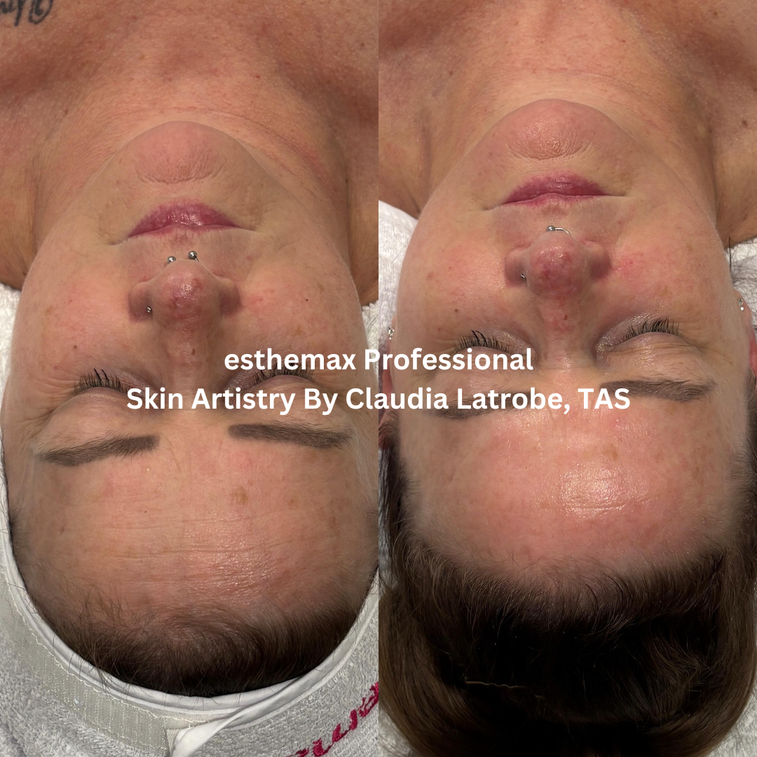 Before and after esthemax Professional facial, showing brighter skin, improved hydration, and a smoother, more radiant complexion.