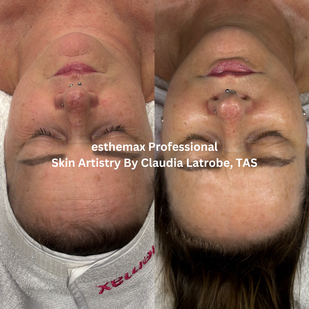 Before and after esthemax Professional facial at Skin Artistry By Claudia, Latrobe TAS, showing increased radiance, smoother texture and a more even complexion.