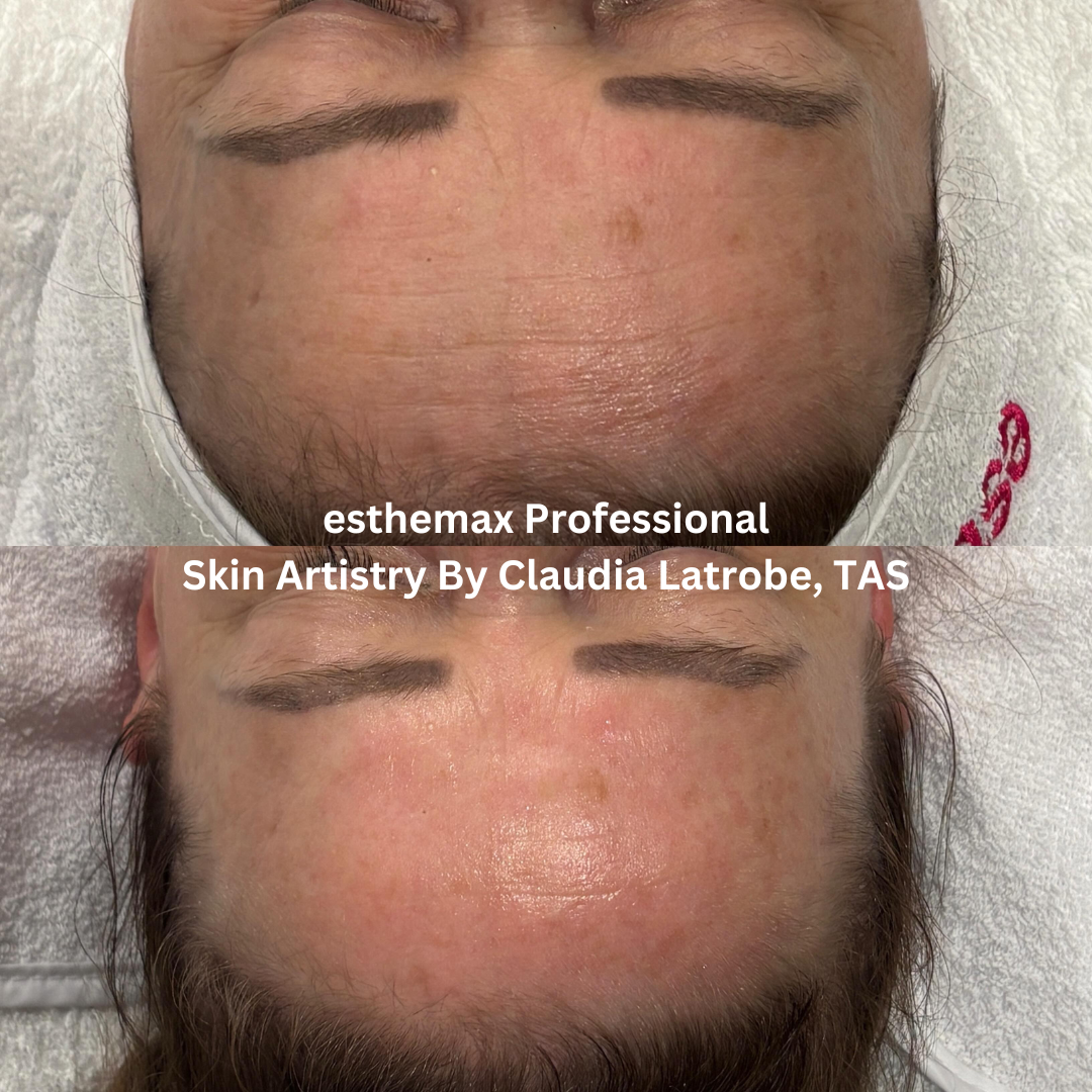 Before and after esthemax Professional facial, showing brighter skin, improved hydration, and a smoother, more radiant complexion.