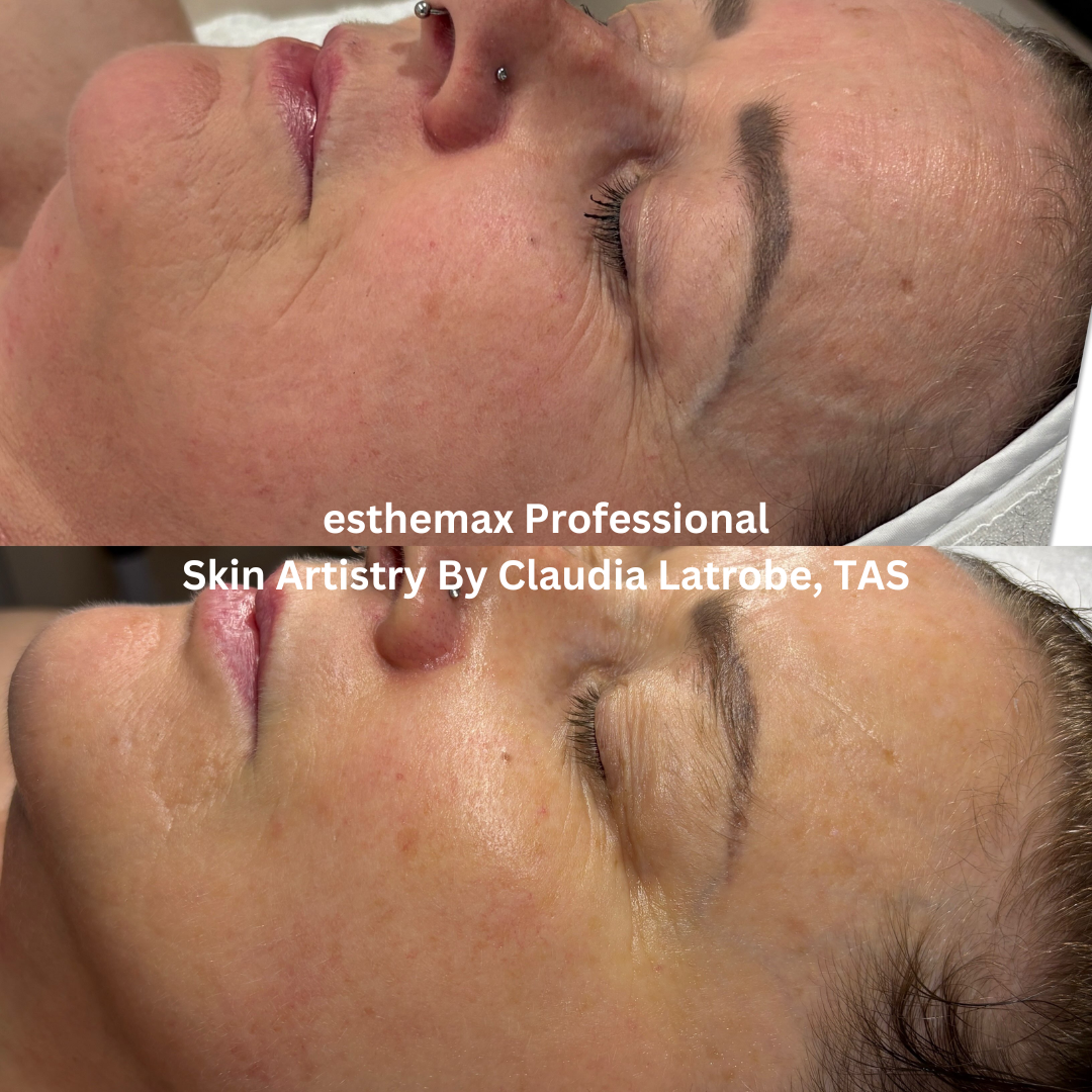 Before and after esthemax Professional facial at Skin Artistry By Claudia, showing brighter-looking skin, improved hydration and smoother texture.