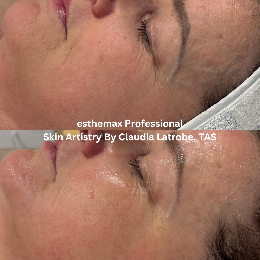Before and after esthemax Professional facial, showing smoother skin texture, improved luminosity, and healthier-looking, hydrated skin.