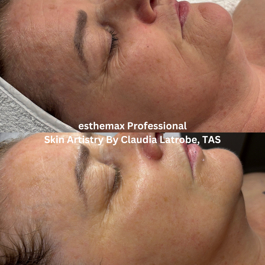 Before and after esthemax Professional facial, highlighting improved luminosity, hydration and smoother-looking skin across the cheek and forehead.